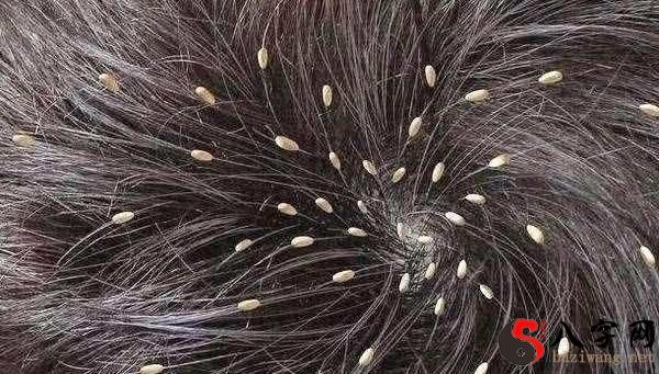 梦见小孩头上很多虱子